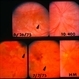 Behcet Uveitis
